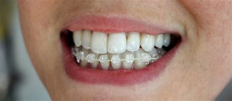 six months smiles metal bracket rebond|Six Month Smiles – Sunny Smile Orthodontics.